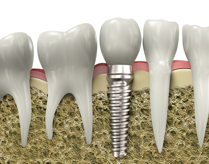 dental implants in Seton