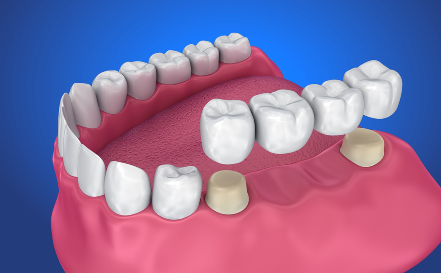 how to select the right dental bridge for you