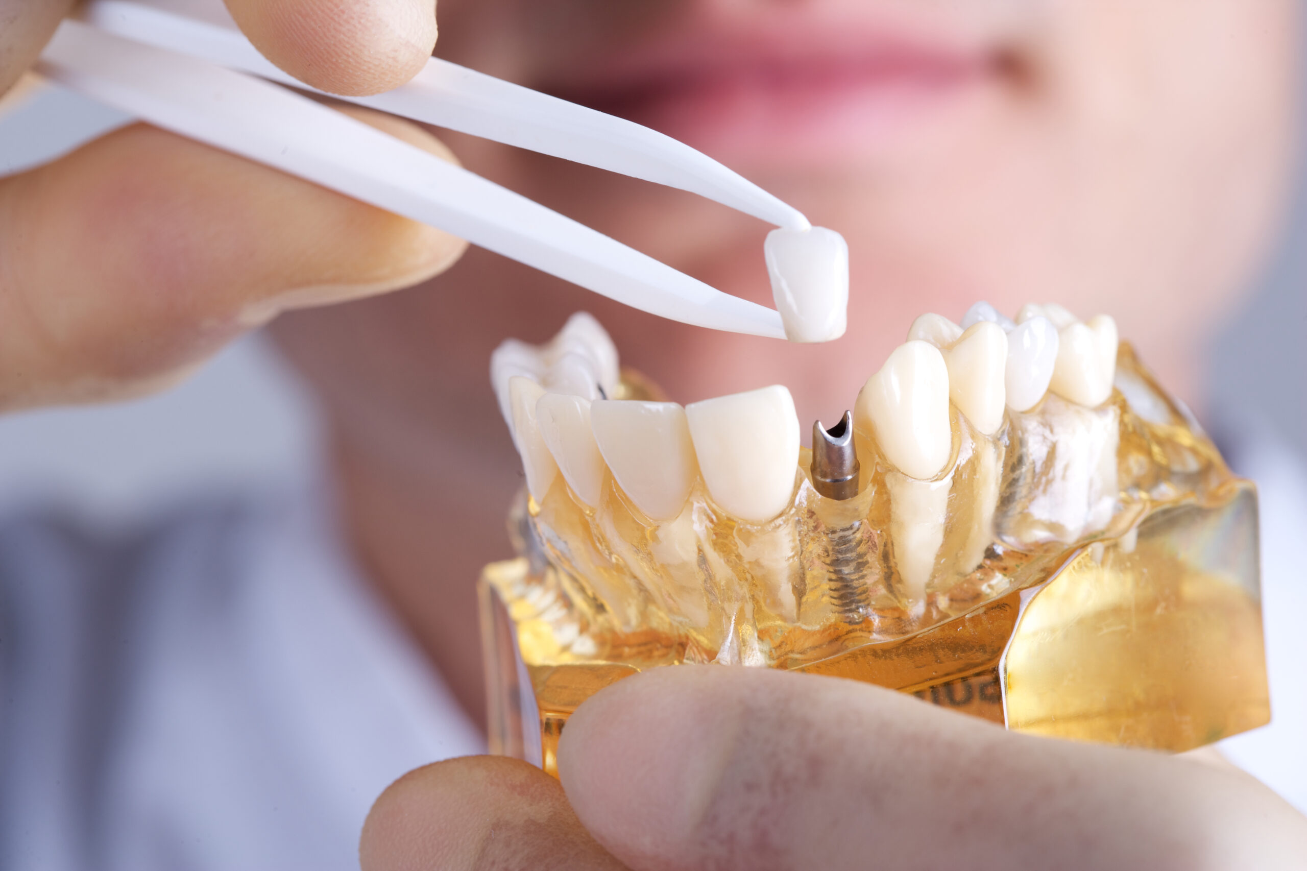 dental implants a permanent tooth replacement to consider