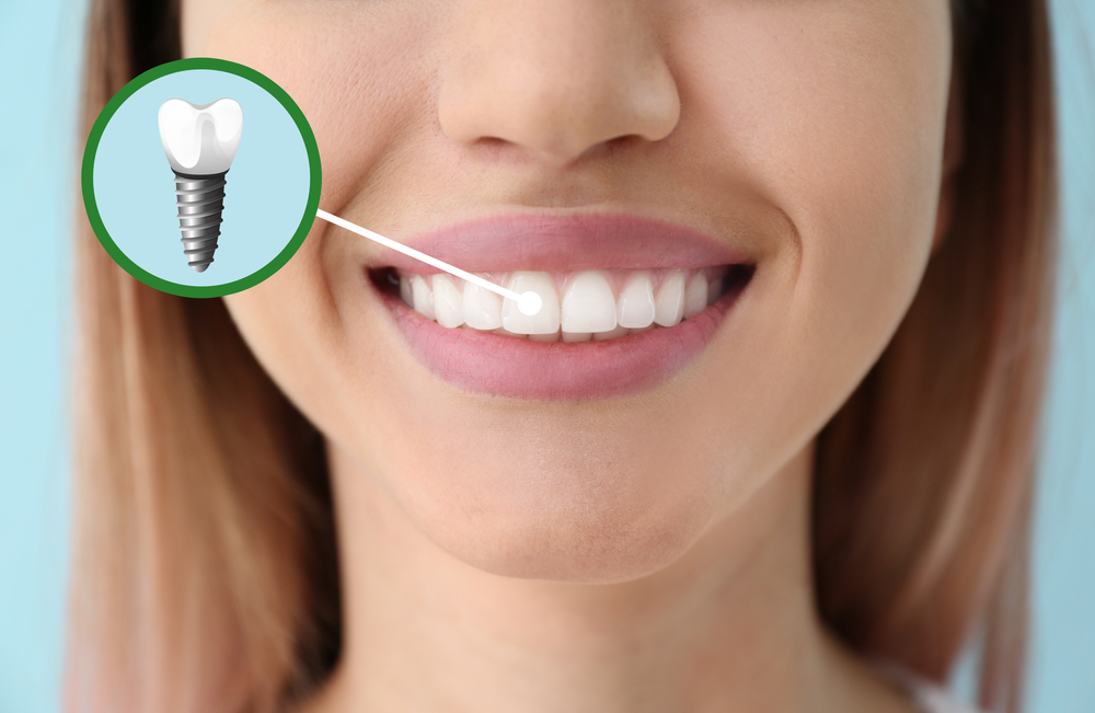 the ultimate guide to dental implants what you need to know