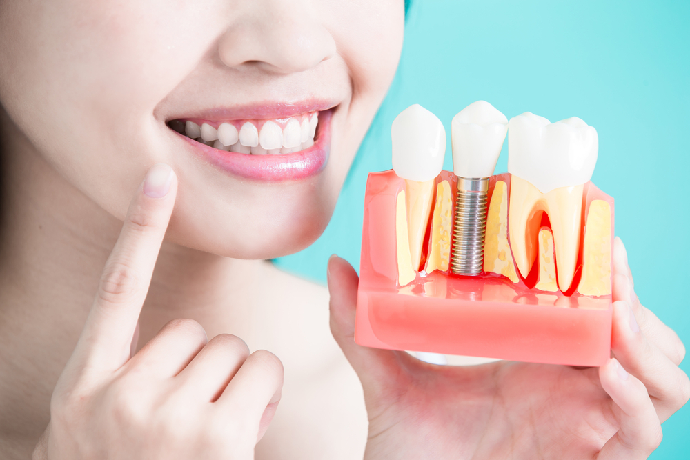 care guide for dental implants